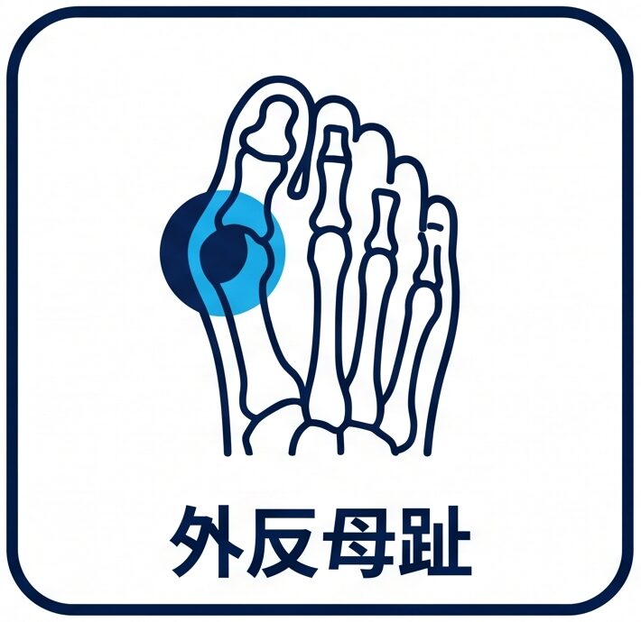 外反母趾の悩み